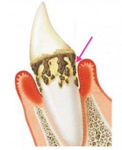 歯周病の原因：歯石