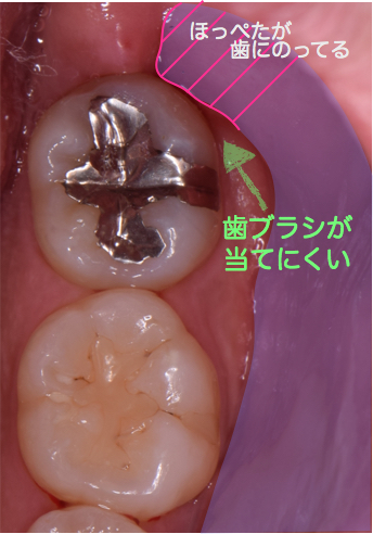 頬粘膜と歯の位置関係