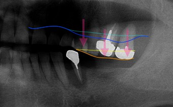 歯と歯周組織が下に移動しまっています。 歯：黄色→オレンジ 骨：水色→青