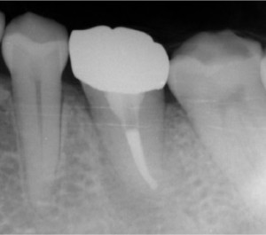 移植歯修復後６ヶ月