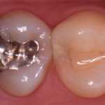 歯の間のむし歯
