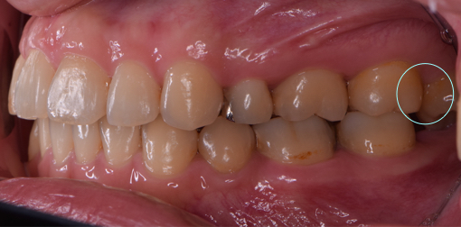 親知らずと奥歯の間のケアができない場合、一番奥の歯に被害が及ぶことがある。
