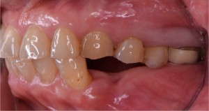 歯がなくなった下のあごのスペースに、上の歯があります。