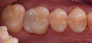 左から２本目の歯がむし歯です。過去に治療を受けている部分もあるようです。