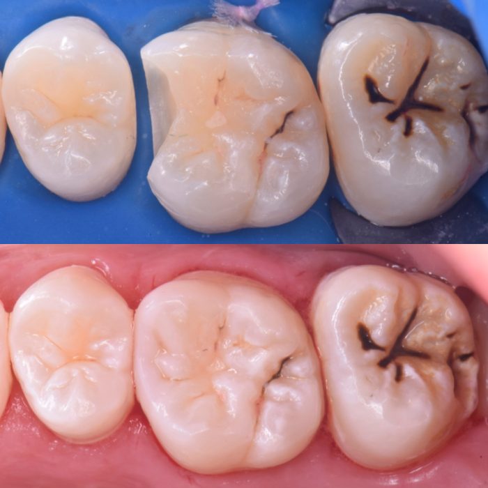 大臼歯のダイレクトボンディング | YF DENTAL OFFICEのブログ