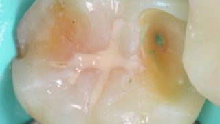 繰り返す再治療によって、神経が死んでしまった歯の治療（前編