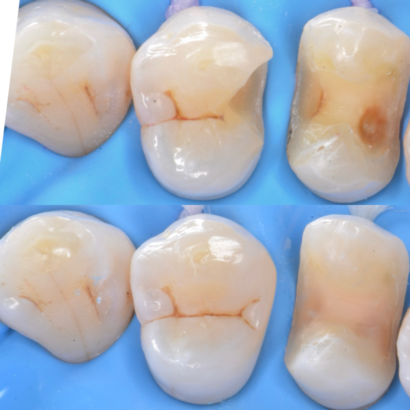 入り組んだむし歯の取り残しを、ダイレクトボンディングで治す