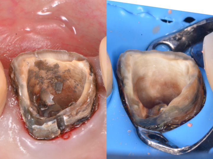 根管治療が長持ちするポイントは治療中の感染防止。基本を守れば長持ちする。